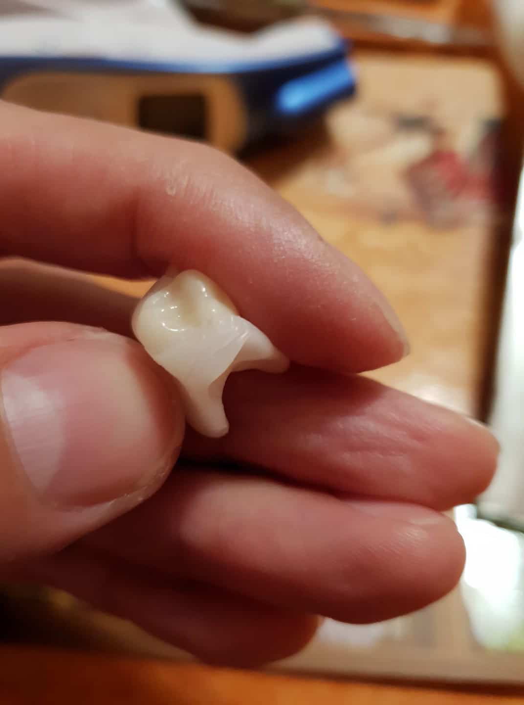 Finálna zubní náhrada Denticor po mesiacoch vývoje