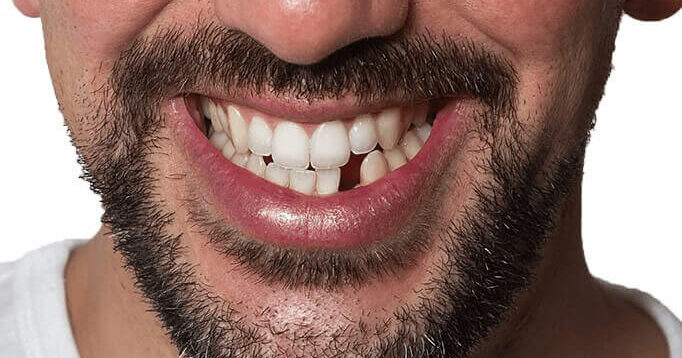 Muž s chybějícím předním zubem — reálný scénář, který Denticor řeší doma za 30 minut