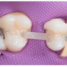 Mostík na skjených vláknach — ilustračná fotka