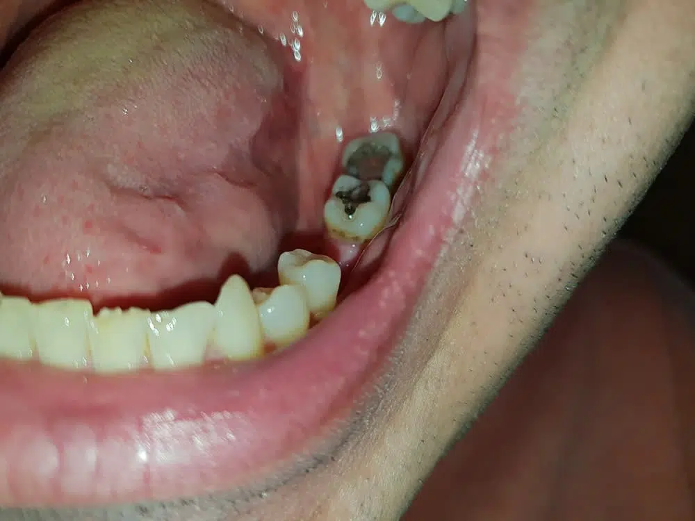 Chybějící zub — mezera před nasazením Denticoru