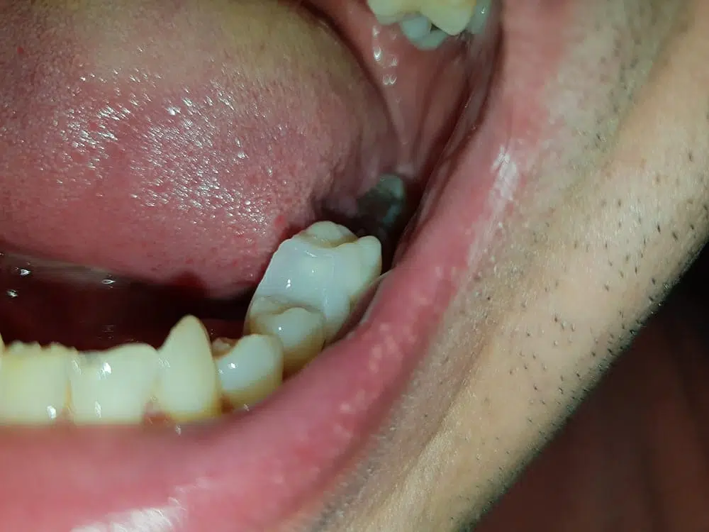 Nasadzovanie nového zubu Denticor do mezery