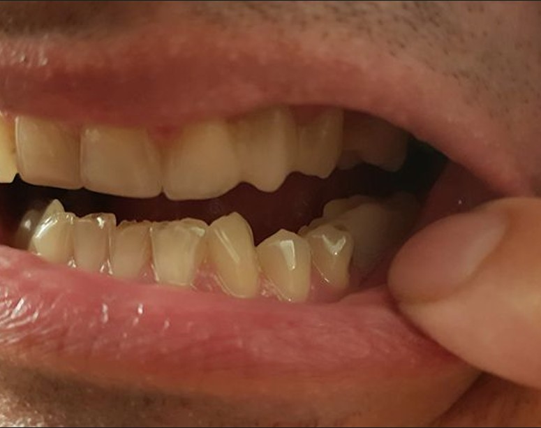 Hotový výsledek — nový zub na místě