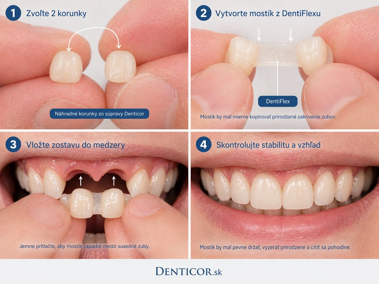 Postup Denticor při chybějících dvou zubech — výběr dvou korunek, vytvorenie spoločního můstku, vloženie a kontrola