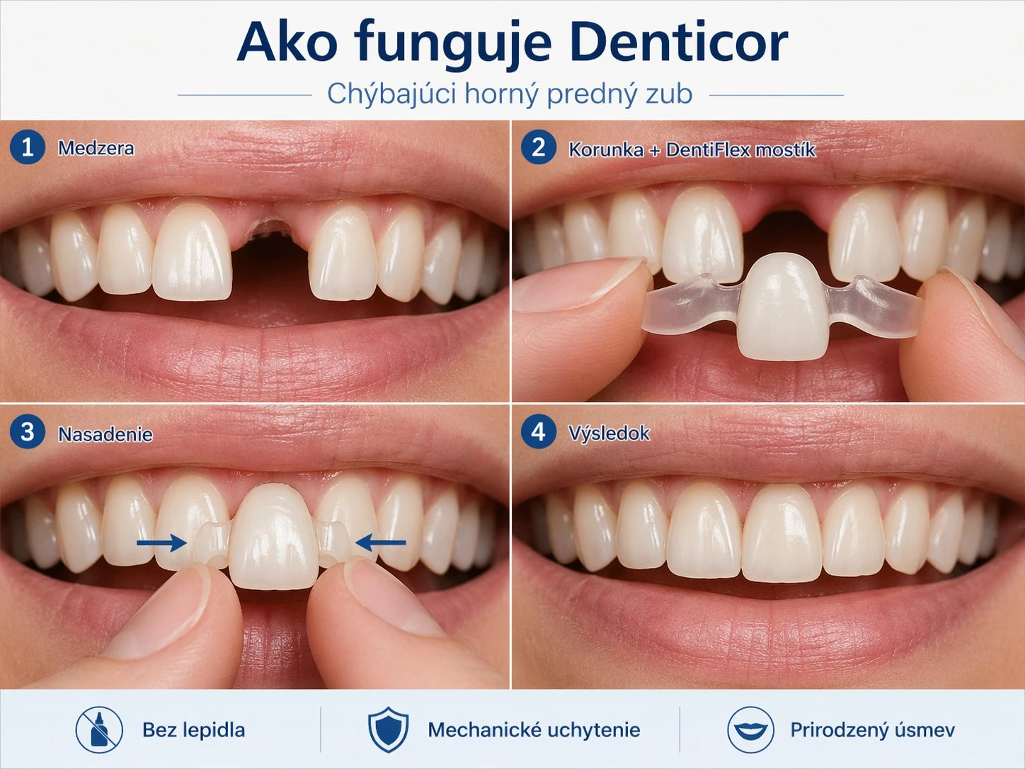 Jak funguje Denticor při chybějícím horním prednom zube — mezera, korunka v DentiFlex můstku, nasazení, výsledek