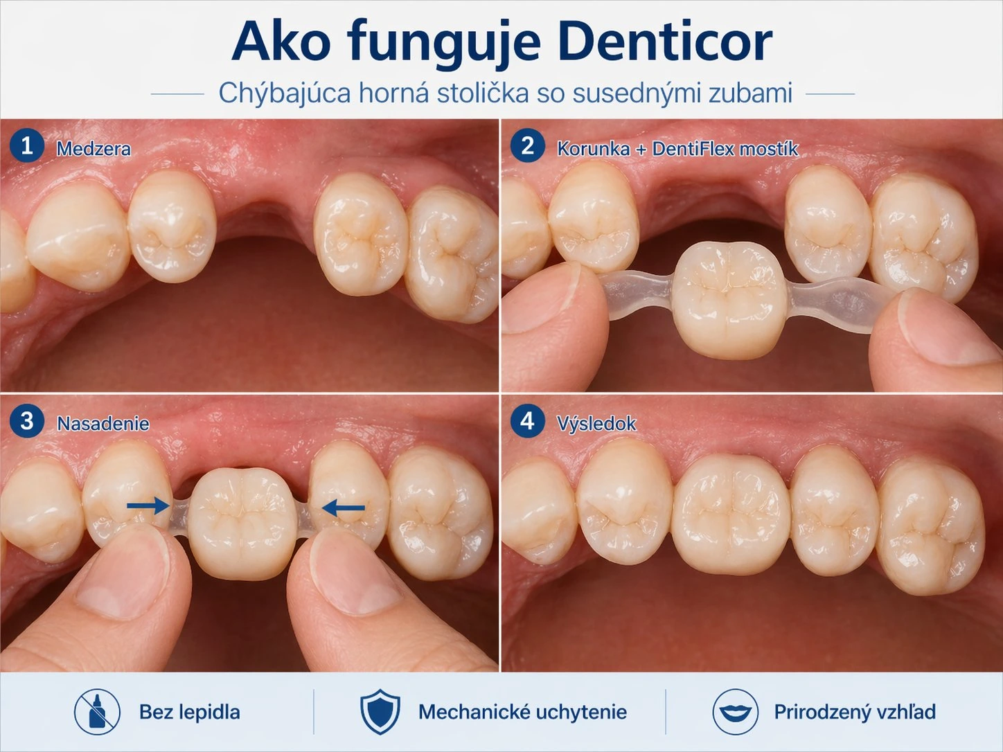 Jak funguje Denticor při chybějící horní stoličke se sousedními zuby — postup v čtyřoch krocích
