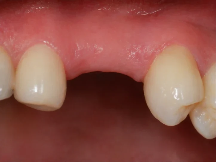 Postup Denticor při očnom zube: zahojená mezera, korunka v DentiFlexe, vloženie mezi zuby a tenký finální můstek