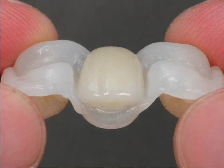 Postup Denticor při očnom zube: zahojená mezera, korunka v DentiFlexe, vloženie mezi zuby a tenký finální můstek