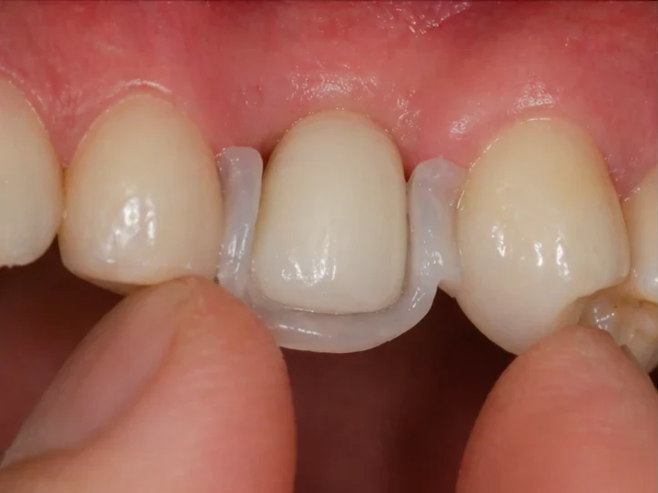 Postup Denticor při očnom zube: zahojená mezera, korunka v DentiFlexe, vloženie mezi zuby a tenký finální můstek