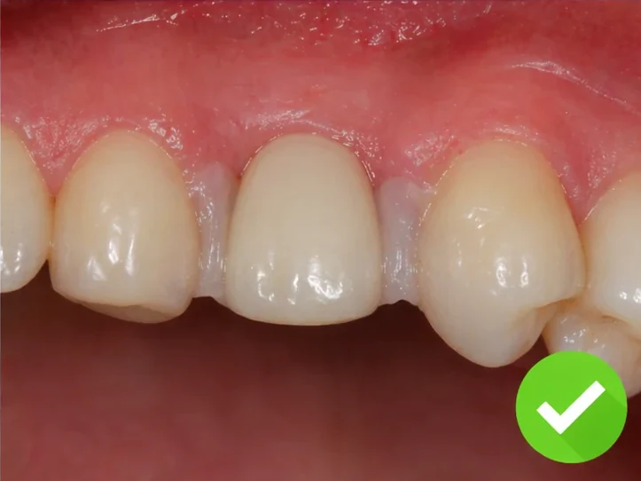 Postup Denticor při očnom zube: zahojená mezera, korunka v DentiFlexe, vloženie mezi zuby a tenký finální můstek