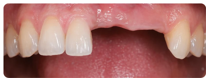 Vizuální postup pro dva premoláre a stoličku dole — princip vloženia Denticor můstku s novými zuby a jeho dotvarovania o okolní zuby