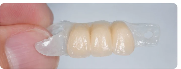 Vizuální postup pro dva premoláre a stoličku dole — princip vloženia Denticor můstku s novými zuby a jeho dotvarovania o okolní zuby