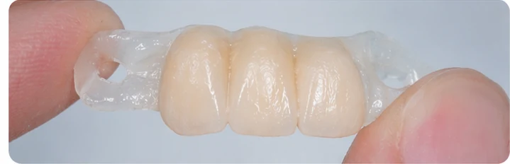 Vizuální postup pro dva premoláre a stoličku dole — princip vloženia Denticor můstku s novými zuby a jeho dotvarovania o okolní zuby