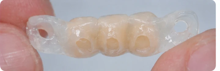 Vizuální postup pro dva premoláre a stoličku dole — princip vloženia Denticor můstku s novými zuby a jeho dotvarovania o okolní zuby