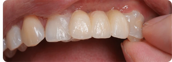 Vizuální postup pro dva premoláre a stoličku dole — princip vloženia Denticor můstku s novými zuby a jeho dotvarovania o okolní zuby