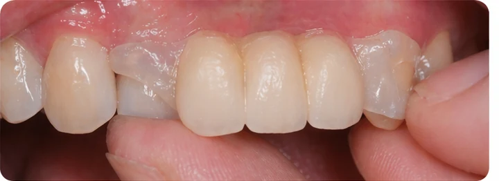 Vizuální postup pro dva premoláre a stoličku dole — princip vloženia Denticor můstku s novými zuby a jeho dotvarovania o okolní zuby