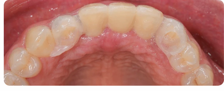 Vizuální postup pro dva premoláre a stoličku dole — princip vloženia Denticor můstku s novými zuby a jeho dotvarovania o okolní zuby