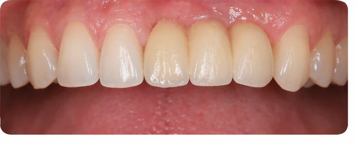 Vizuální postup pro dva premoláre a stoličku dole — princip vloženia Denticor můstku s novými zuby a jeho dotvarovania o okolní zuby