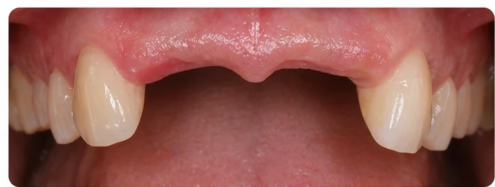 Vizuální postup pro dva sousední dolní přední zuby — princip vloženia Denticor můstku s novými zuby a jeho dotvarovania o okolní zuby