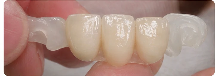 Vizuální postup pro dva sousední dolní přední zuby — princip vloženia Denticor můstku s novými zuby a jeho dotvarovania o okolní zuby