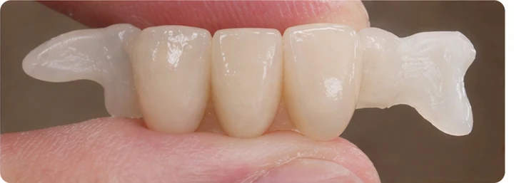 Vizuální postup pro dva sousední dolní přední zuby — princip vloženia Denticor můstku s novými zuby a jeho dotvarovania o okolní zuby