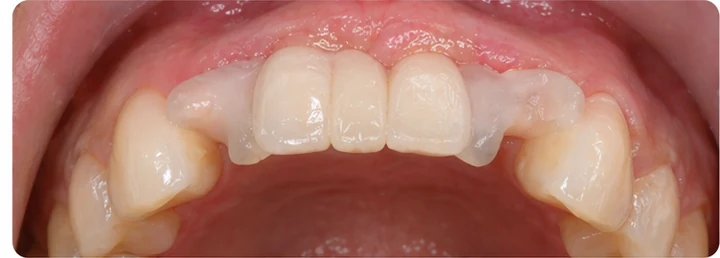 Vizuální postup pro dva sousední dolní přední zuby — princip vloženia Denticor můstku s novými zuby a jeho dotvarovania o okolní zuby