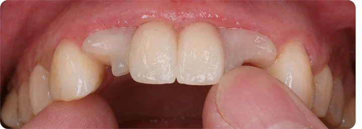 Vizuální postup pro dva sousední dolní přední zuby — princip vloženia Denticor můstku s novými zuby a jeho dotvarovania o okolní zuby