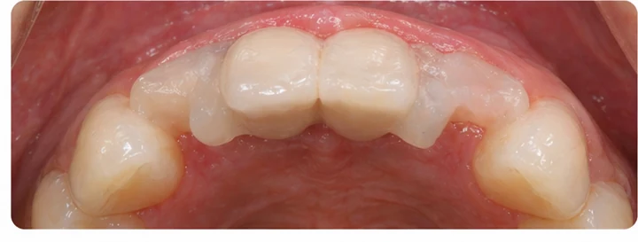 Vizuální postup pro dva sousední dolní přední zuby — princip vloženia Denticor můstku s novými zuby a jeho dotvarovania o okolní zuby