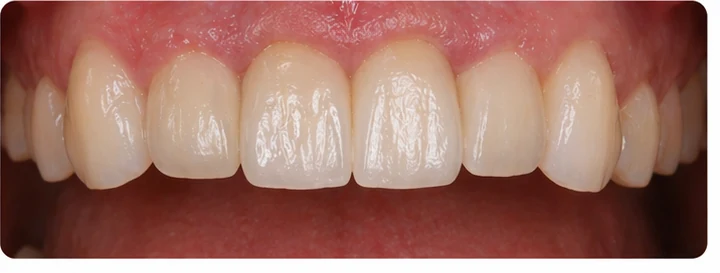 Vizuální postup pro dva sousední dolní přední zuby — princip vloženia Denticor můstku s novými zuby a jeho dotvarovania o okolní zuby