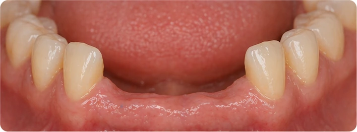 Vizuální návod — chybějící horní oční zub a premolár