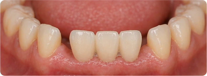 Kontrola velikosti korunek v mezeře