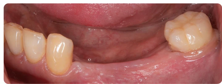 Vizuální postup pro tři zadní zuby dole — princip vloženia Denticor můstku s novými zuby a jeho dotvarovania o okolní zuby