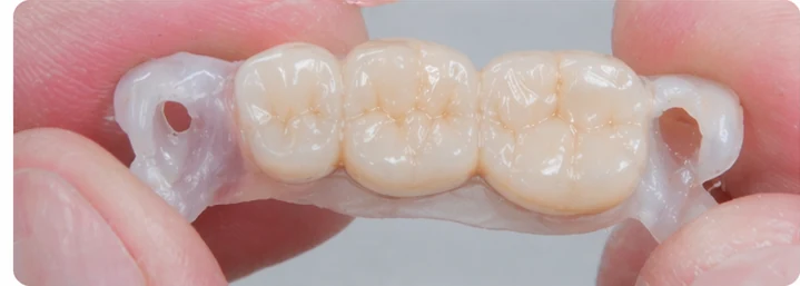 Vizuální postup pro tři zadní zuby dole — princip vloženia Denticor můstku s novými zuby a jeho dotvarovania o okolní zuby