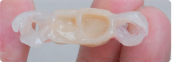 Vizuální postup pro tři zadní zuby dole — princip vloženia Denticor můstku s novými zuby a jeho dotvarovania o okolní zuby