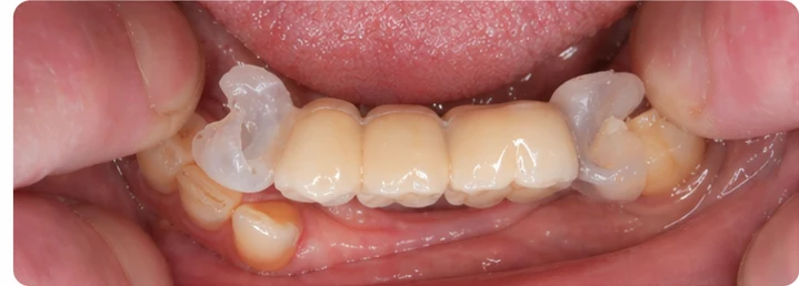 Vizuální postup pro tři zadní zuby dole — princip vloženia Denticor můstku s novými zuby a jeho dotvarovania o okolní zuby