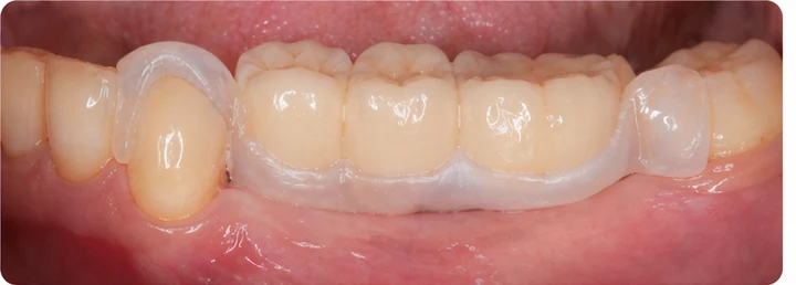 Vizuální postup pro tři zadní zuby dole — princip vloženia Denticor můstku s novými zuby a jeho dotvarovania o okolní zuby