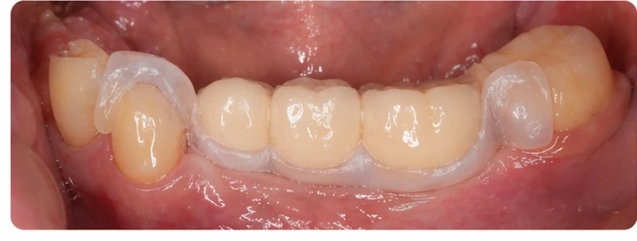 Vizuální postup pro tři zadní zuby dole — princip vloženia Denticor můstku s novými zuby a jeho dotvarovania o okolní zuby