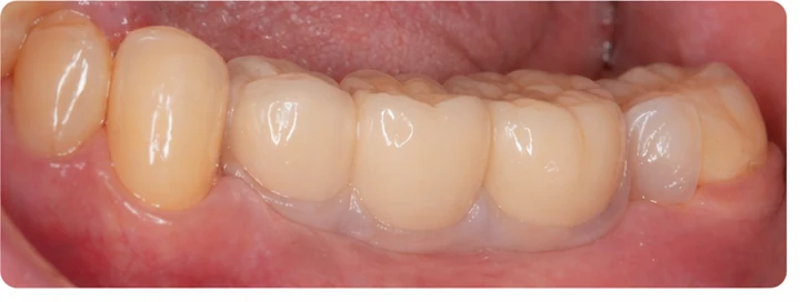 Vizuální postup pro tři zadní zuby dole — princip vloženia Denticor můstku s novými zuby a jeho dotvarovania o okolní zuby