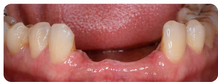 Vizuální postup pro oční zub a dva premoláre dole — princip vloženia Denticor můstku s novými zuby a jeho dotvarovania o okolní zuby