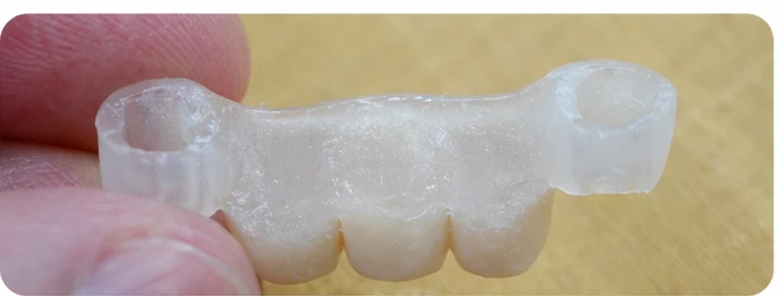 Vizuální postup pro oční zub a dva premoláre dole — princip vloženia Denticor můstku s novými zuby a jeho dotvarovania o okolní zuby