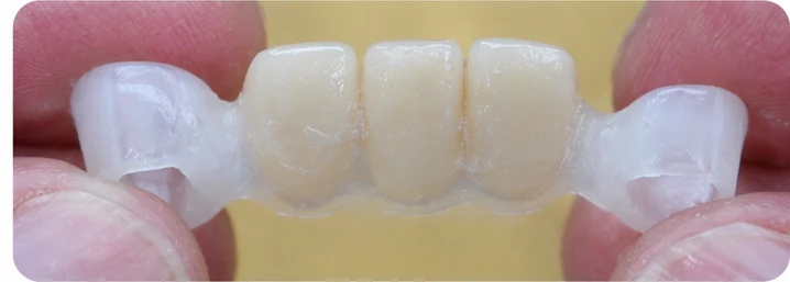 Vizuální postup pro oční zub a dva premoláre dole — princip vloženia Denticor můstku s novými zuby a jeho dotvarovania o okolní zuby