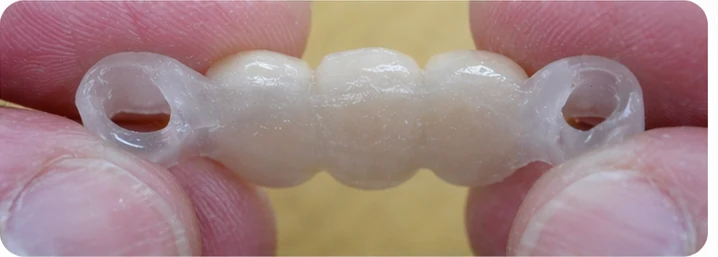 Vizuální postup pro oční zub a dva premoláre dole — princip vloženia Denticor můstku s novými zuby a jeho dotvarovania o okolní zuby