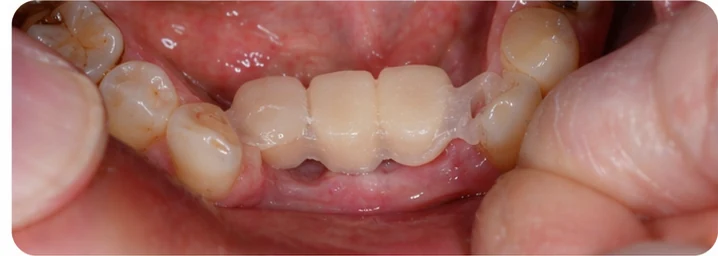 Vizuální postup pro oční zub a dva premoláre dole — princip vloženia Denticor můstku s novými zuby a jeho dotvarovania o okolní zuby