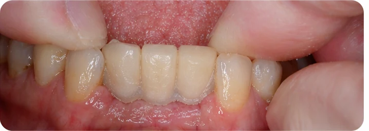 Vizuální postup pro oční zub a dva premoláre dole — princip vloženia Denticor můstku s novými zuby a jeho dotvarovania o okolní zuby