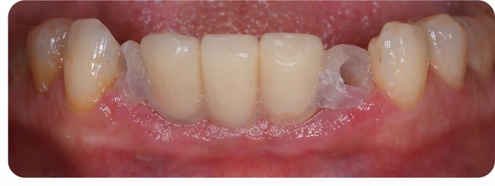 Vizuální postup pro oční zub a dva premoláre dole — princip vloženia Denticor můstku s novými zuby a jeho dotvarovania o okolní zuby