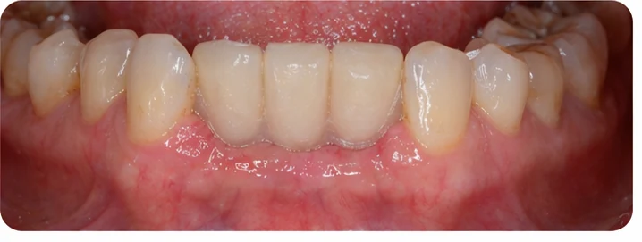 Vizuální postup pro oční zub a dva premoláre dole — princip vloženia Denticor můstku s novými zuby a jeho dotvarovania o okolní zuby