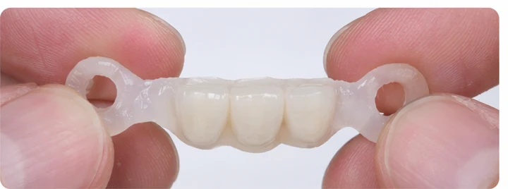 Vizuální postup pro tři sousední zuby v dolním oblúku — princip vloženia Denticor můstku s novými zuby a jeho dotvarovania o okolní zuby