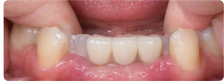 Vizuální návod — chybějící tři přední horní zuby