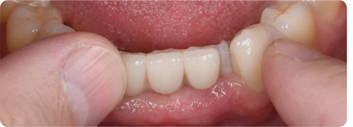 Vizuální návod — chybějící tři přední horní zuby