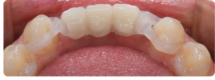 Vizuální návod — chybějící tři přední horní zuby