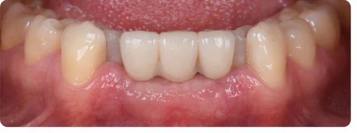 Vizuální postup pro tři sousední zuby v dolním oblúku — princip vloženia Denticor můstku s novými zuby a jeho dotvarovania o okolní zuby